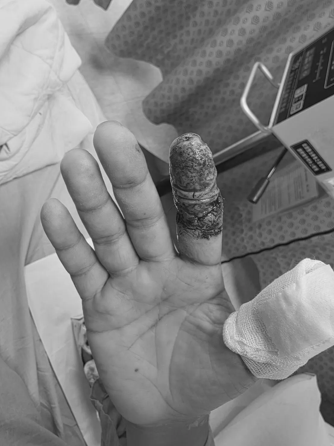 再接手指的血流極度脆弱，任何血栓都可能讓前功盡棄。豐原醫院提供