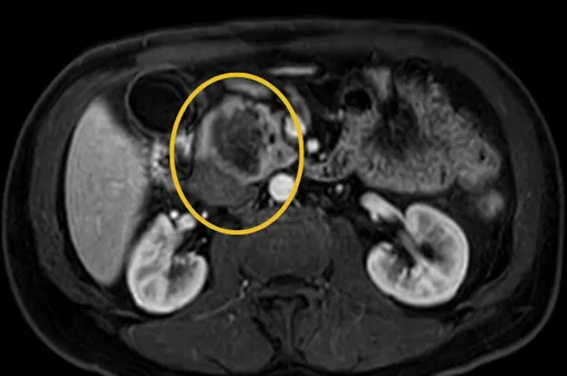 一滴血就能揪出胰臟癌　台大最新研究解癌王魔咒
