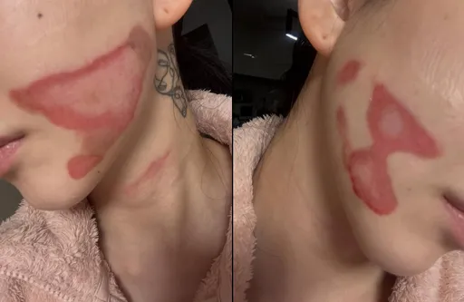 珉娥醫美慘遭毀容！雙頰二度燒傷　痛喊絕望