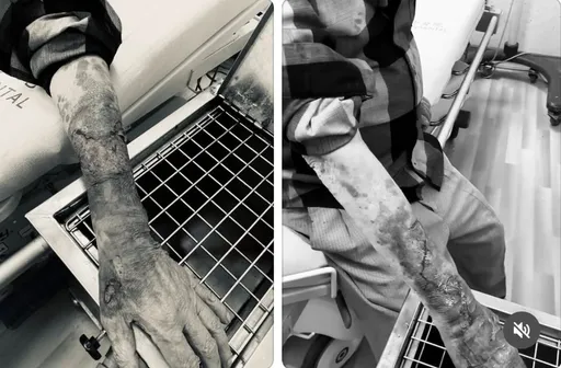 台中翁不明原因遭攔車攻擊　手臂皮膚被扯落！駭人傷勢曝光