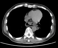 63歲男CT顯示遠端食道裂傷。阮綜合提供