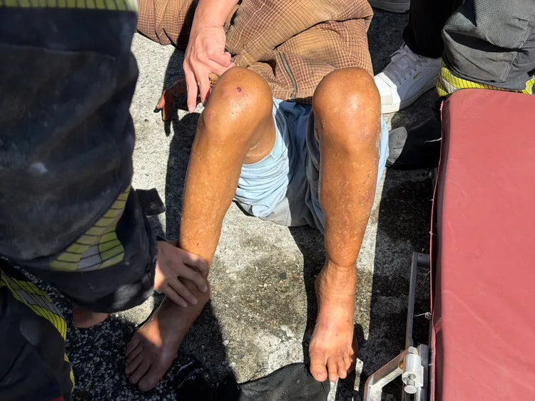 屋主逃出火場摔傷腳被緊急送醫治療。消防局提供