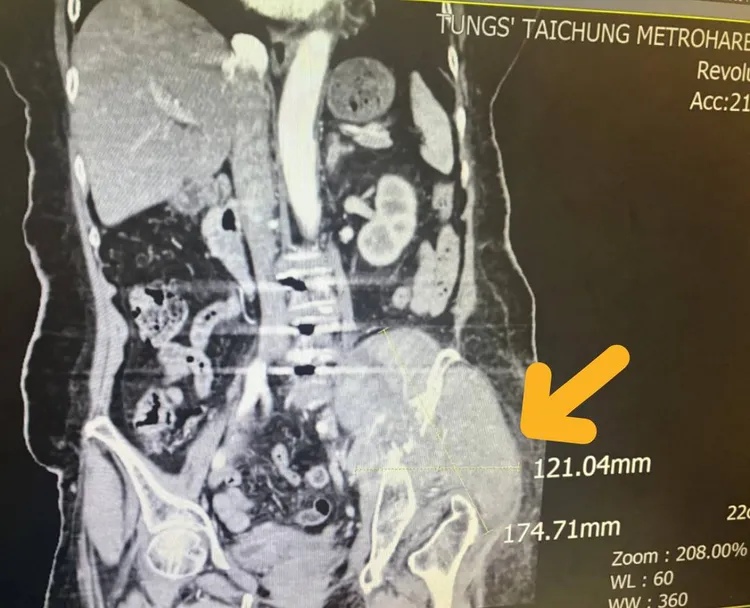 黃色箭頭即為患者左側骨盆骶骨處出現異常12.1公分x17.4公分左右大型腫瘤細胞。童綜合醫院提供