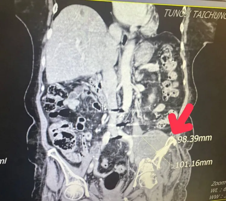 銳視刀治療後腫瘤已經縮小至9.8公分x10.1公分左右。童綜合醫院提供
