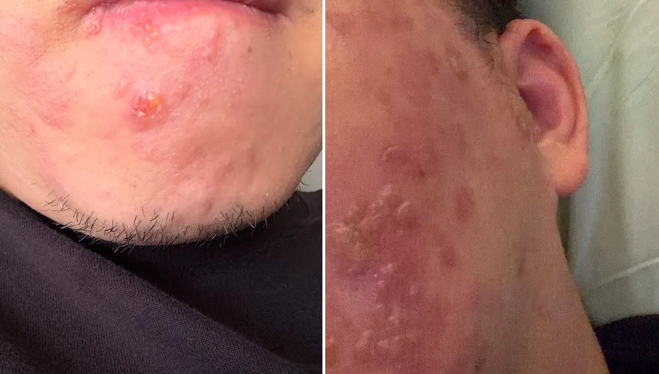 工程師牙痛失眠3天　拔牙還是痛！竟是皮蛇造成恐「白拔了」