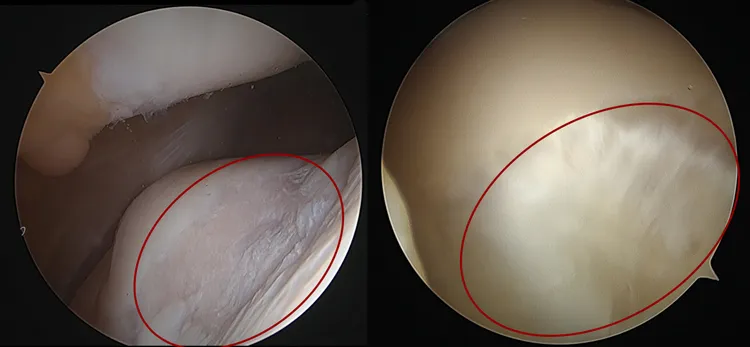 關節鏡頭下膝蓋軟骨損傷情形(左)，經自體軟骨移植，成功再生(右)。中港澄清提供