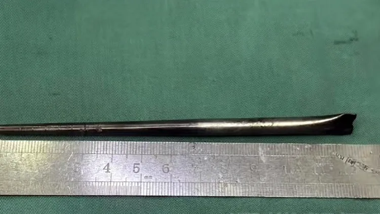 王男近來因為患部疼痛加劇就醫，終於通過手術取出在咽部卡了8年的筷子。翻攝自微博