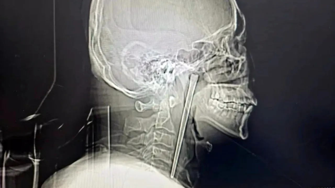 他誤吞「12公分金屬筷」卡住了　竟放棄治療讓它在咽部待8年