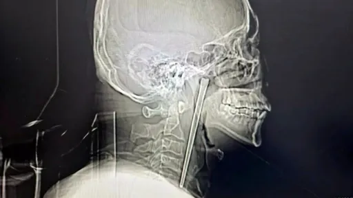 他誤吞「12公分金屬筷」卡住了　竟放棄治療讓它在咽部待8年