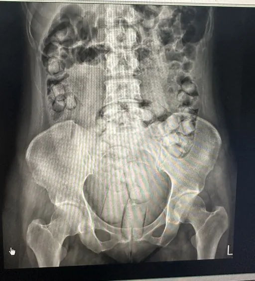 2泰女吞海洛因「60顆藏肚內」機場現形　驚人畫面曝光