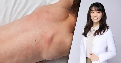 日本麻疹疫情升溫！醫師示警疫苗別拖　幼兒恐成高風險族群