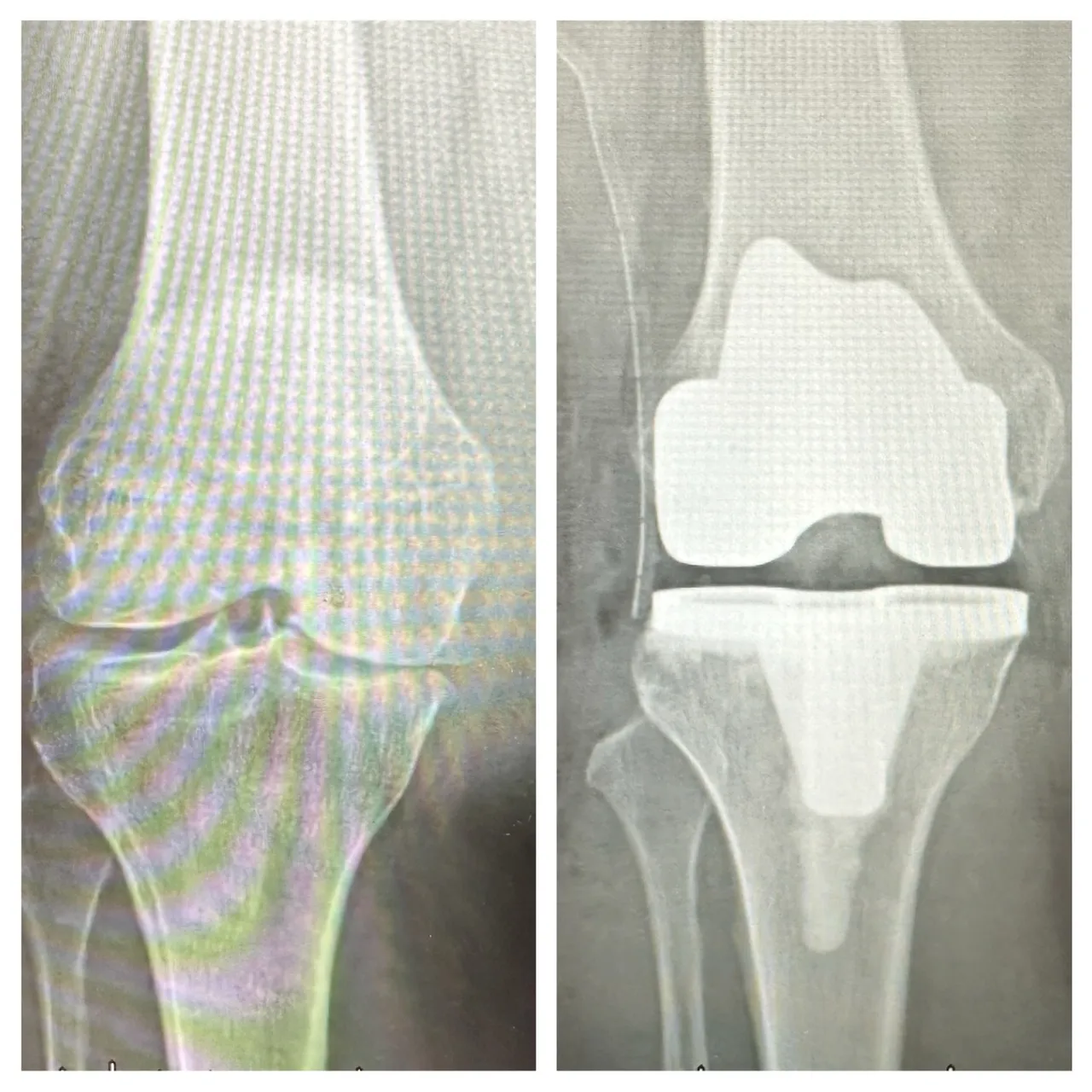 梁奶奶順利完成膝關節「人工關節置換手術」，術後疼痛明顯改善，短時間內即可重新站立並行走。豐原醫院提供