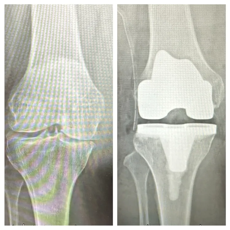 梁奶奶順利完成膝關節「人工關節置換手術」，術後疼痛明顯改善，短時間內即可重新站立並行走。豐原醫院提供