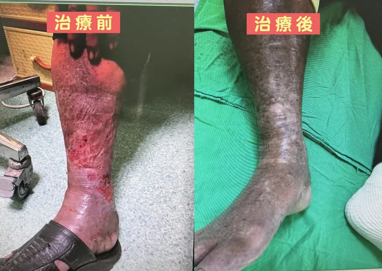 治療前後對比。烏日林新提供