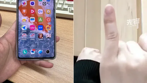 小拇指當手機架10年　她劇痛求醫：別說擰毛巾，沒法用筷子