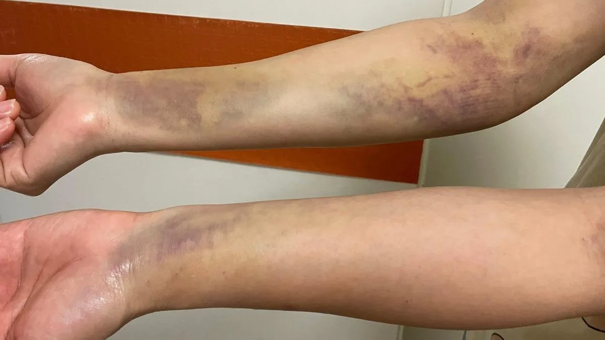 黃慧婷出院後淤青更嚴重，康復中。翻攝黃慧婷臉書