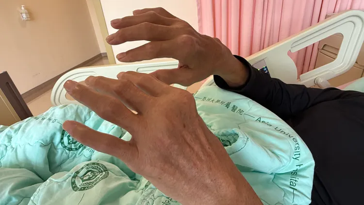 患者雙手也長有痛風石。亞大附醫提供