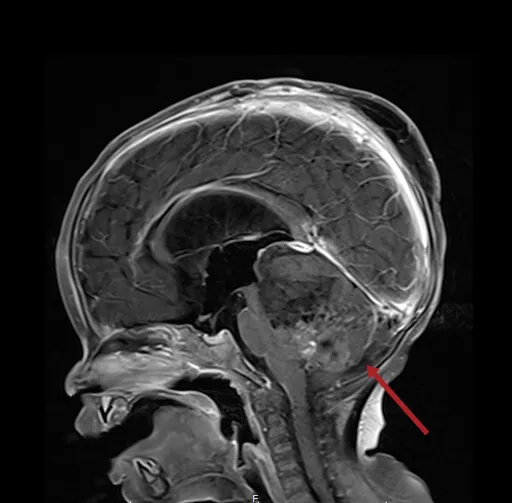 惡性腦瘤難預測　醫揭早期警訊與治療方式