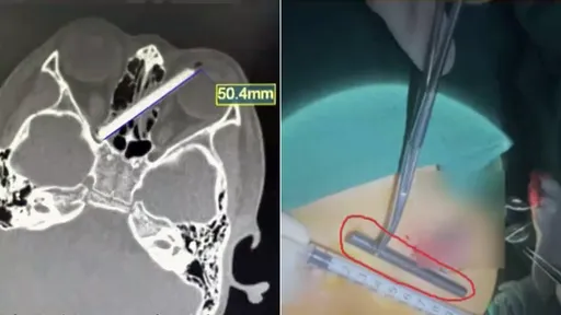 吃飯拿筷子摔一跤　5cm斷筷插向7歲童眼球