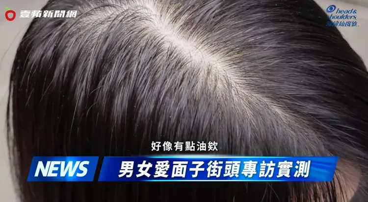 頭皮除了出油，還會生頭皮屑，代表頭皮油水不平衡。