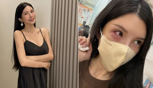 「國光女神」情傷心痛眼睛哭出問題！用針刺眼痛到大叫　連跑4診所