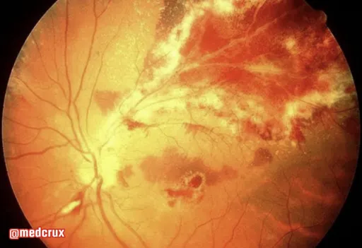 視力變差當心！他飛蚊症險瞎　一檢查崩潰：愛滋病晚期