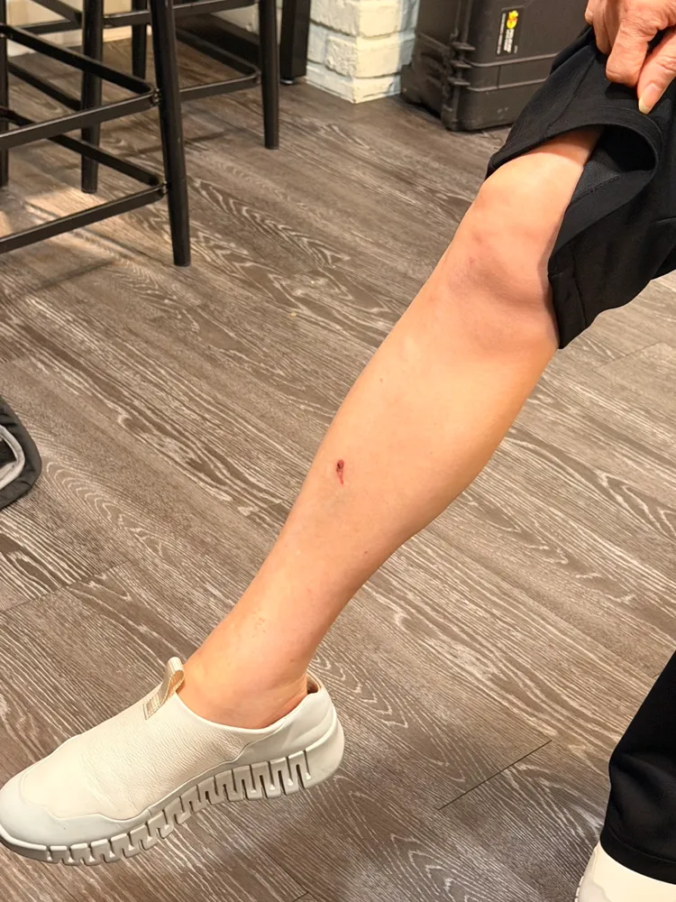 辛曉琪撩起褲管秀出腳上的傷勢。林丞偉攝