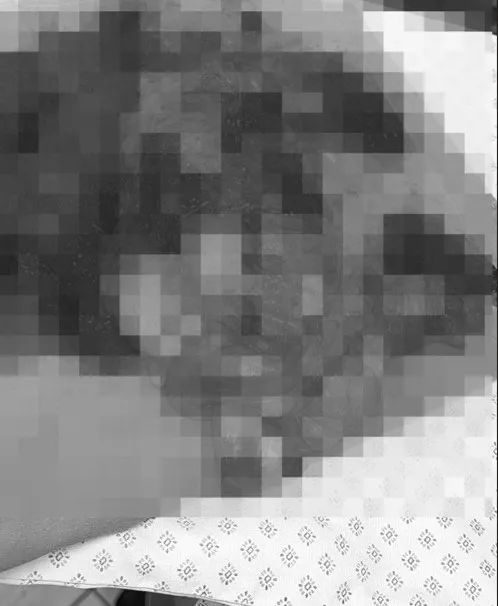 女子做完抽脂手術後發生病變，切除約20公分多處穿孔的大腸才保住性命(經過變色處理)。投訴人提供