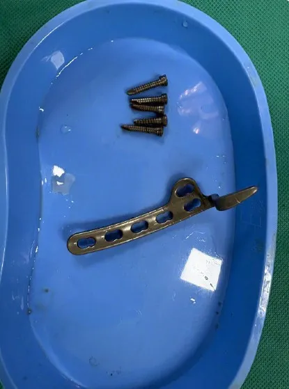 陳哲遠去年12月取出鋼釘及鉤狀固定器。翻攝陳哲遠微博