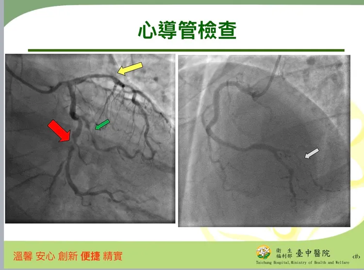 患者進行新導管檢查，發現有包括左側左前降支、左迴旋支、以及右側冠狀動脈嚴重狹窄（左圖）。台中醫院提供