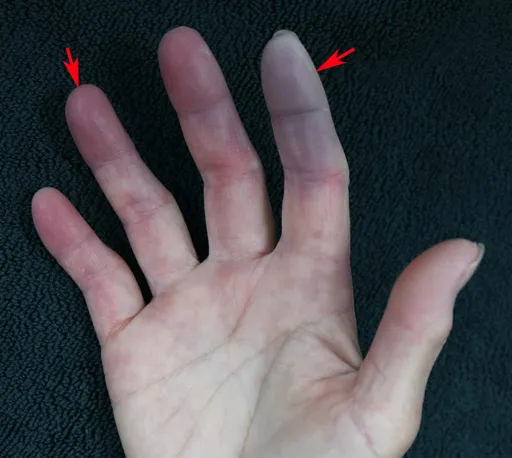 64歲男天氣冷手指就變紫色　原來是全身性硬化症作祟