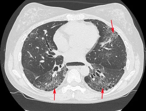 全身硬化症合併肺纖維化(箭頭指處)。中榮提供