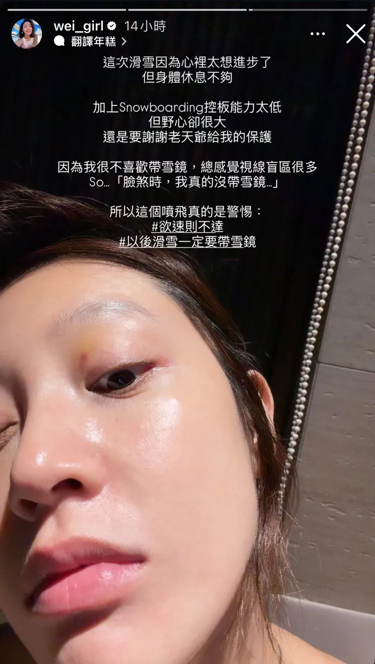 黃薇渟眼皮泛出瘀青。翻攝自黃薇渟IG