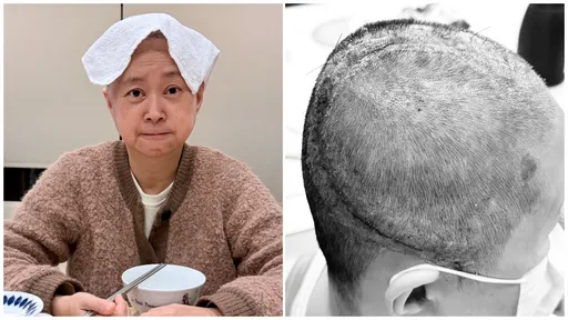 王月開顱巨大傷疤曝光　「感謝將我從生死邊緣帶回的那雙手」