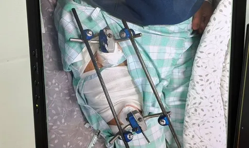 30歲男日本滑雪摔斷腿　驚見6公分不明骨腫瘤！急返台就醫