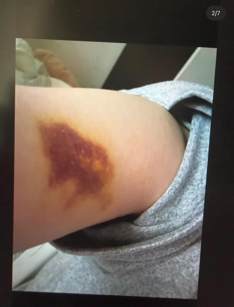 Jisoo大嫂手臂被打到瘀青。翻攝theqoo