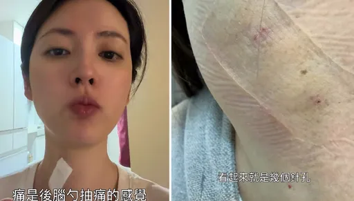 阿諾長出喉結動完消融手術！脖子留針孔　後腦勺抽痛