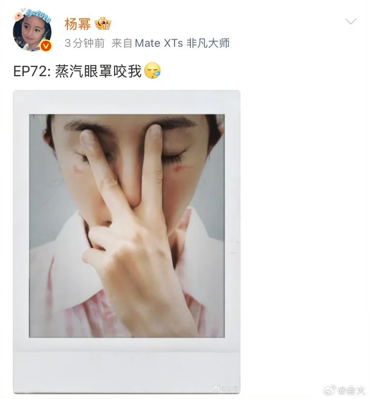 楊冪曬燙傷照和粉絲討拍。翻攝自楊冪微博