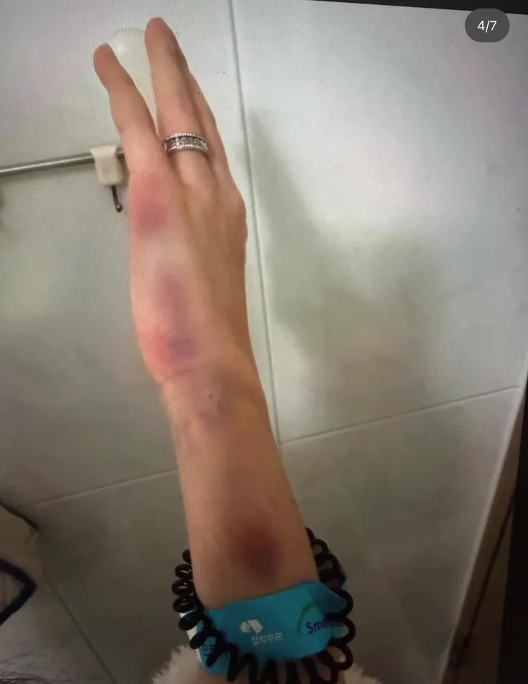 手上有多處瘀青傷痕。翻攝theqoo