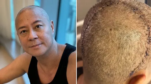 「草蜢」蔡一傑開刀除腦瘤留下巨大傷疤　隔天卻得知癌細胞已擴散