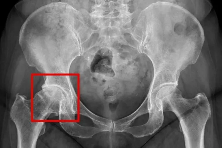 X光檢查下的退化性關節炎，紅框處可見髖關節軟骨磨損嚴重，導致骨頭間縫隙狹窄、引發發炎與疼痛。台北慈濟醫院提供