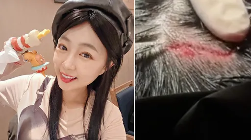 丫頭38歲生日摔破頭樂極生悲！傷口釘5針怵目驚心