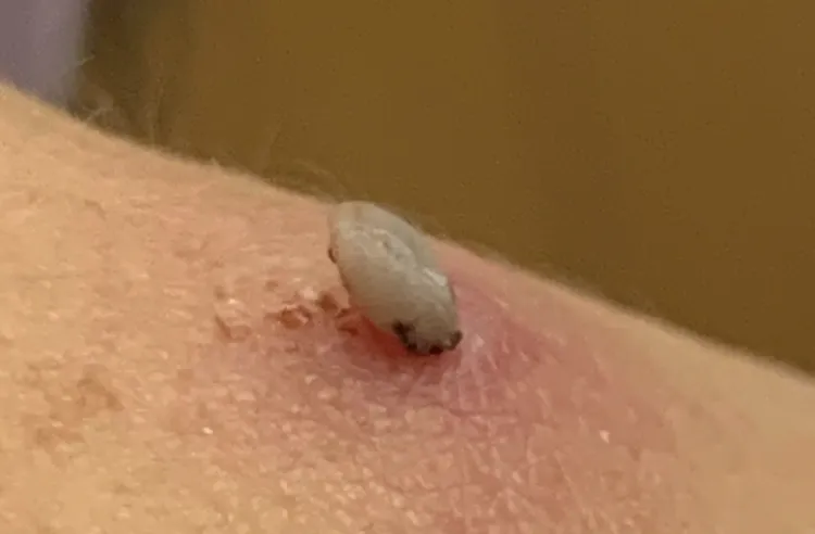 蜱蟲叮咬會造成產生高燒、無力等症狀，甚至發生萊姆病。翻攝畫面