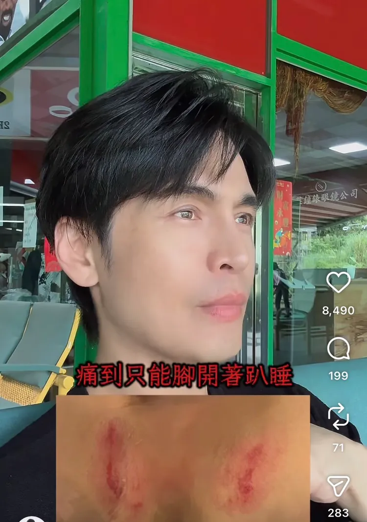 Gino秀出當時騎馬的傷口照。翻攝自Gino IG