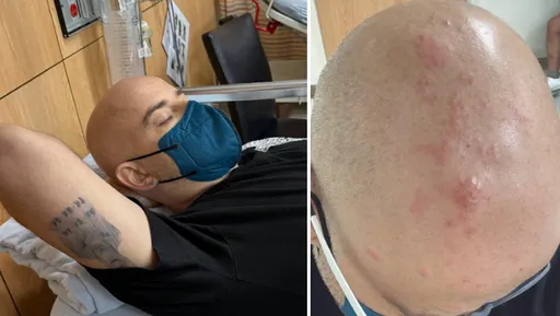 吳鳳皰疹長到頭皮蔓延耳朵！疼痛程度超乎他想像