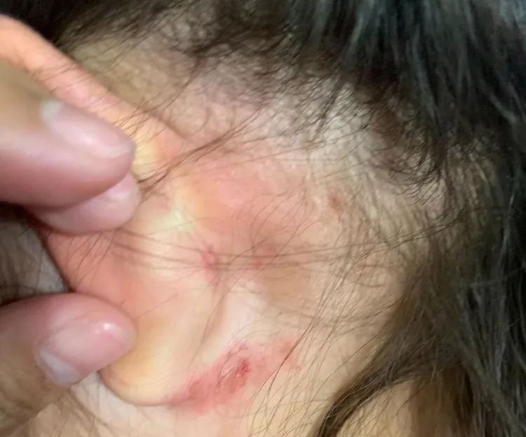 5歲女童耳後被抓傷。翻攝Threads