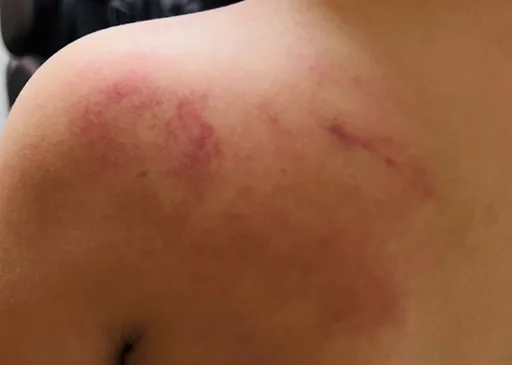 沒立即回應就被打！拍3下即讓5歲女童後背紅腫　家長氣炸提告幼教師