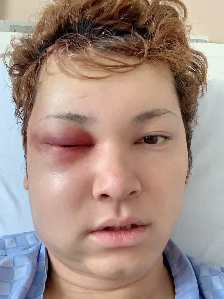 間瀨翔太開刀後面目全非。翻攝本人IG