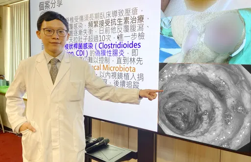 洪金寶也受惠！56歲男腹瀉血便　植入「健康糞便」重建腸道健康