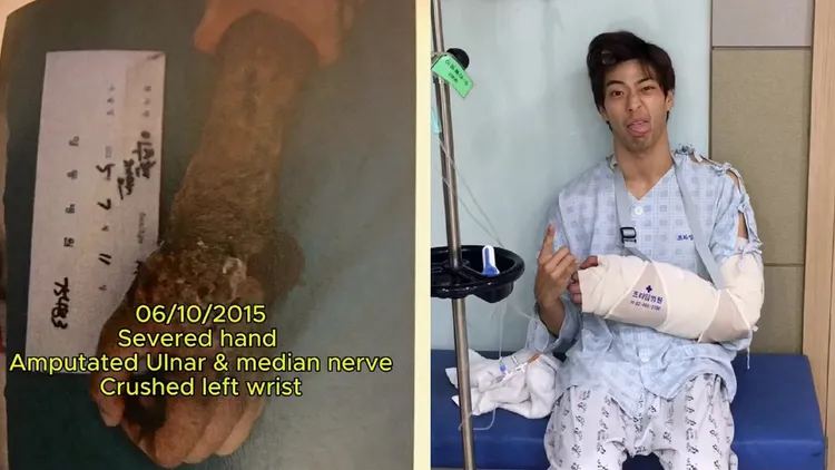李銖銜2015年遭遇意外，左手受重傷。翻攝李銖銜IG